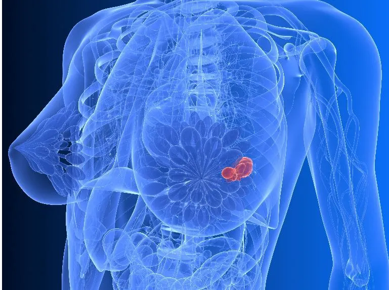 Screening gratuit pentru depistarea cancerului mamar, la Miercurea Ciuc