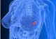 Screening gratuit pentru depistarea cancerului mamar, la Miercurea Ciuc